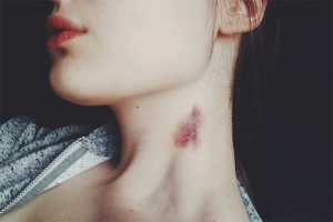  How to get rid of a hickey