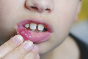  Wie behandelt man Stomatitis bei einem Kind?