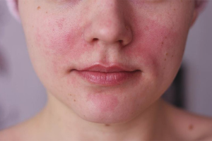  Hoe zich te ontdoen van rosacea op het gezicht