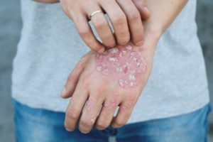  Hoe psoriasis behandelen